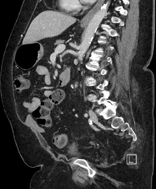 Colon adenocarcinoma (Radiopaedia 59374-66735 C 33).jpg