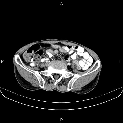 Colon adenocarcinoma - hepatic flexure (Radiopaedia 85635-101395 A 66).jpg