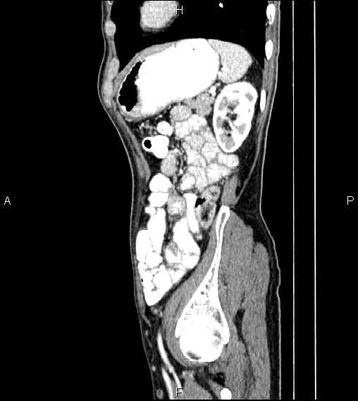 Colon adenocarcinoma - hepatic flexure (Radiopaedia 85635-101395 D 71).jpg