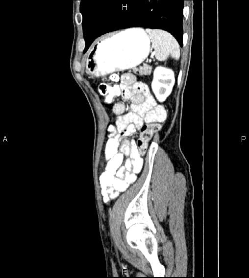 Colon adenocarcinoma - hepatic flexure (Radiopaedia 85635-101395 D 74).jpg