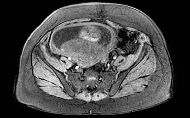 Colon adenocarcinoma with Krukenberg tumors, advanced pregnancy (Radiopaedia 67279-76645 A 25).jpg
