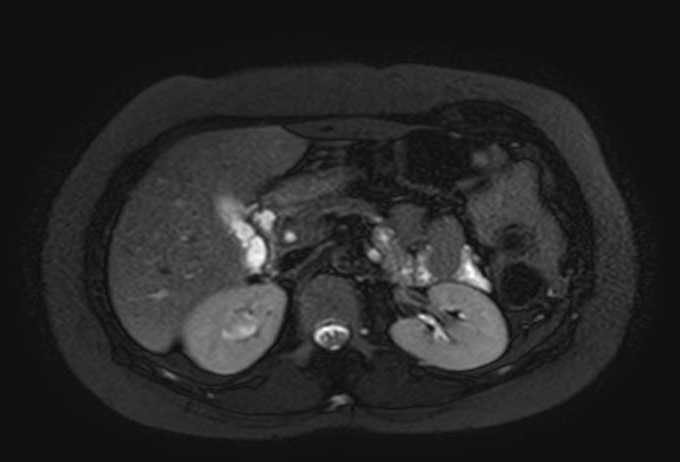 Colon adenocarcinoma with Krukenberg tumors, advanced pregnancy (Radiopaedia 67279-76645 Axial T2 SPAIR 58).jpg
