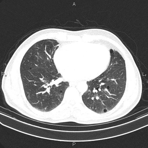 File:Colon cancer (Radiopaedia 85663-101443 Axial lung window 42).jpg