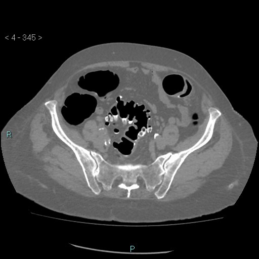 Colonic lipomas (Radiopaedia 49137-54244 Axial bone window 153).jpg