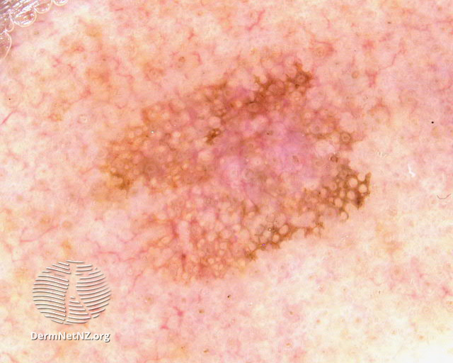 File:Dermoscopy of pigmented actinic keratosis (DermNet NZ pigmented-actinic-keratosis5).jpg