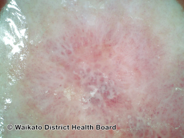 File:Intraepidermal carcinoma, nonpolarised dermoscopy view (DermNet NZ 180044).jpg