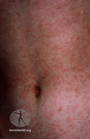 File:Koplik spots (DermNet NZ viral-measles).jpg