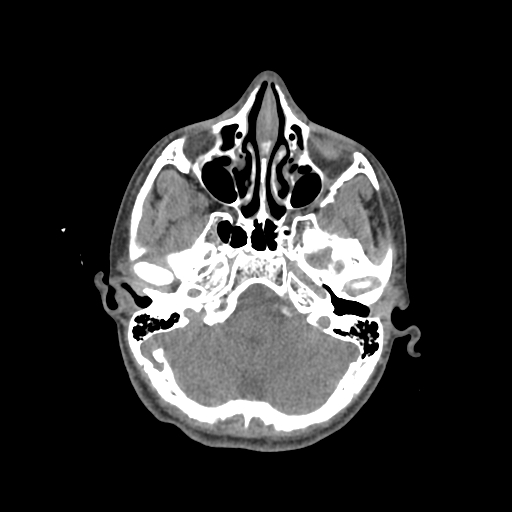 Nasal pyogenic granuloma (lobular capillary hemangioma) (Radiopaedia 85536-101244 Axial non-contrast 73).jpg