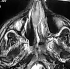 File:Nasal septum hematoma (Radiopaedia 6778-7968 Axial T2 1).jpg
