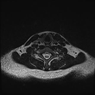 Nasopharyngeal carcinoma with perineural spread (Radiopaedia 55030-61380 Axial T2 71).jpg
