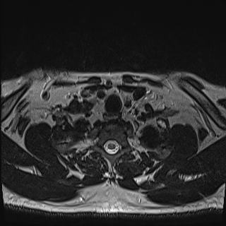 Nasopharyngeal carcinoma with perineural spread (Radiopaedia 55030-61380 Axial T2 82).jpg