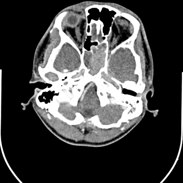 Nasopharyngeal carcinoma with skull base invasion (Radiopaedia 53415-59705 A 17).jpg
