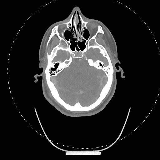 Neck CT angiogram (intraosseous vascular access) (Radiopaedia 55481-61945 B 279).jpg