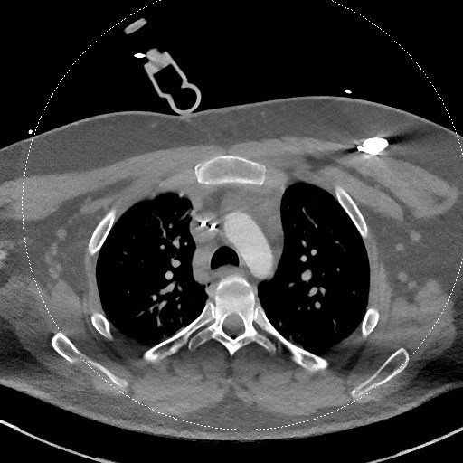 File:Neck CT angiogram (intraosseous vascular access) (Radiopaedia 55481-61945 B 54).jpg