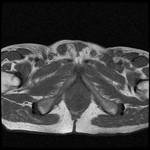 File:Necrotizing epididymo-orchitis with intra-testicular abscess (Radiopaedia 29397-29860 Axial T1 7).jpg