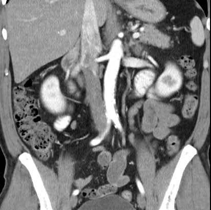 File:Necrotizing pancreatitis with acute necrotic collection (Radiopaedia 14470-14417 C 22).jpg