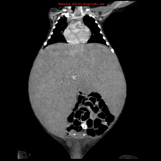 File:Neonatal neuroblastoma (Radiopaedia 9564-10223 B 55).jpg