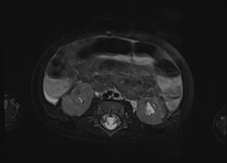 Neonatal prostatic utricle abscess - cyst (Radiopaedia 69511-79394 Axial T2 fat sat 41).jpg