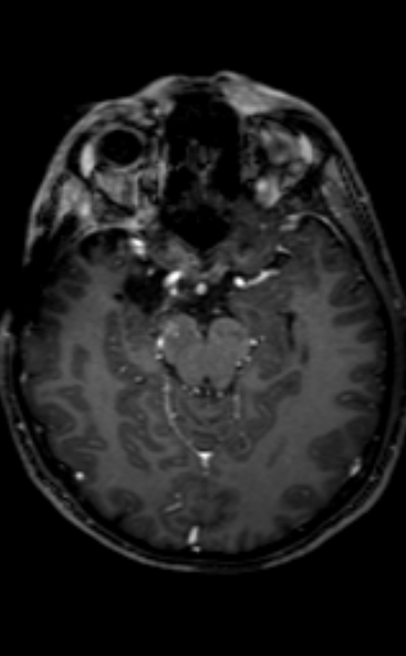 Neuro-Behçet disease (Radiopaedia 90112-107294 Axial T1 C+ 146).jpg
