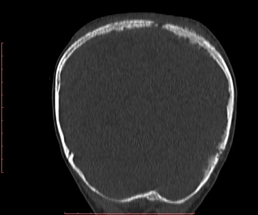 File:Neuroblastoma skull metastasis (Radiopaedia 56053-62683 Coronal bone window 33).jpg
