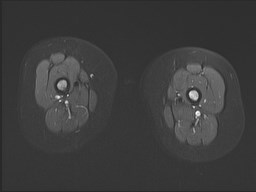 File:Neuroblastoma with bone metastases (Radiopaedia 67080-76414 Axial STIR 26).jpg