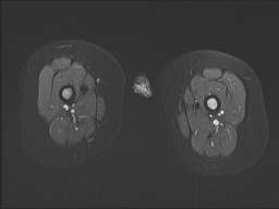 File:Neuroblastoma with bone metastases (Radiopaedia 67080-76414 Axial STIR 27).jpg