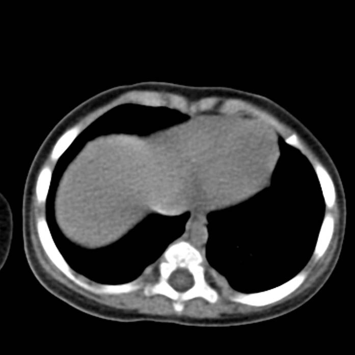Neuroblastoma with skull metastases (Radiopaedia 30326-30960 Axial non-contrast 2).jpg