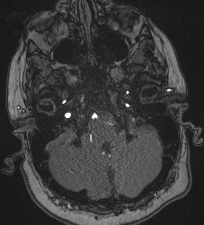 Neurofibromatosis type 1 - head and neck - CNS manifestations (Radiopaedia 49910-55188 Axial MRA 8).png