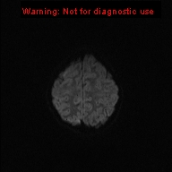 File:Neurofibromatosis type 1 with optic nerve glioma (Radiopaedia 16288-15965 Axial DWI 52).jpg