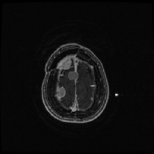 Neurofibromatosis type 2 (Radiopaedia 45229-49244 Axial T1 C+ 103).png