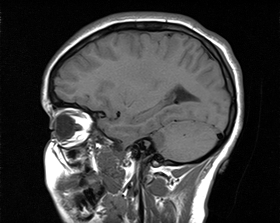 File:Neurofibromatosis type 2 (Radiopaedia 66211-75401 Sagittal T1 18).jpg