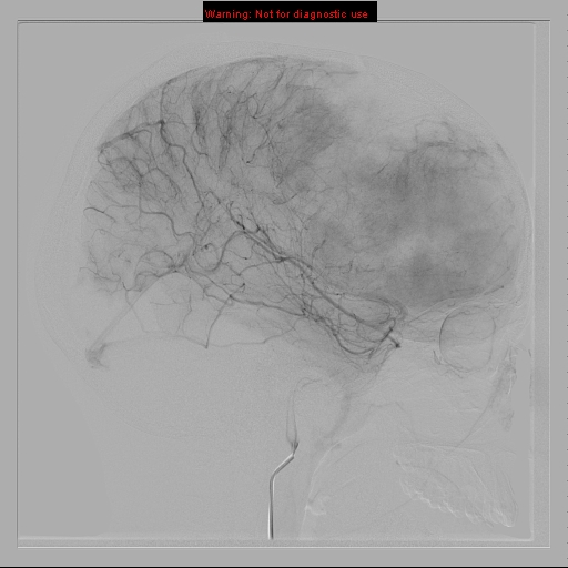 File:Neurofibromatosis type 2 (Radiopaedia 8953-9733 C 14).jpg