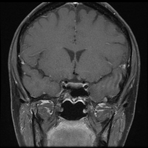File:Neurofibromatosis type 2 - bilateral acoustic neuromata (Radiopaedia 40060-42566 Coronal T1 C+ 12).png