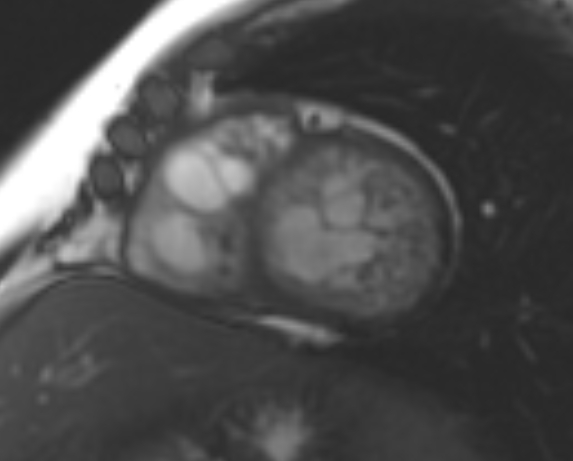 File:Non-compaction of the left ventricle (Radiopaedia 69436-79314 Short axis cine 101).jpg