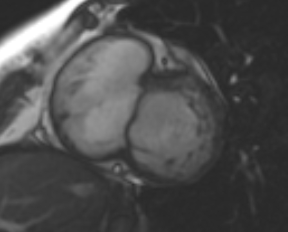 File:Non-compaction of the left ventricle (Radiopaedia 69436-79314 Short axis cine 178).jpg