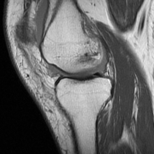 File:Non-displaced patella fracture (Radiopaedia 15932-15582 Sagittal T1 7).jpg
