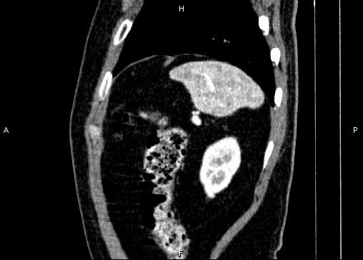 Non-syndromic pancreatic endocrine tumor (Radiopaedia 86958-103178 E 88).jpg