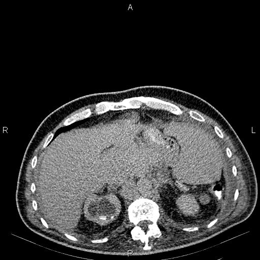 Non Hodgkin lymphoma in a patient with ankylosing spondylitis (Radiopaedia 84323-99621 Axial C+ delayed 16).jpg