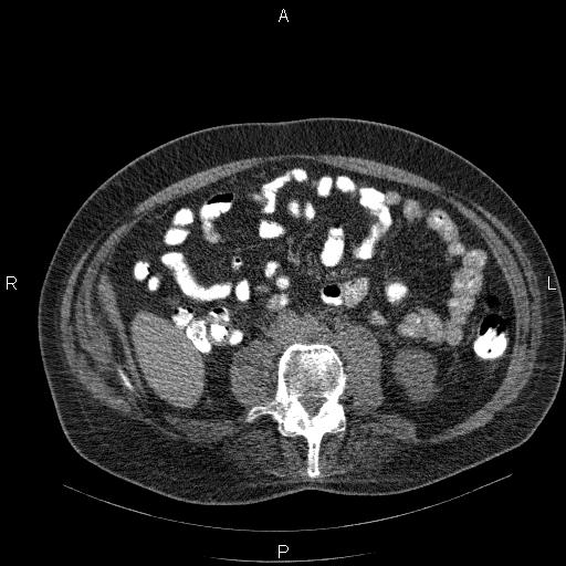 File:Non Hodgkin lymphoma in a patient with ankylosing spondylitis (Radiopaedia 84323-99624 Axial non-contrast 46).jpg