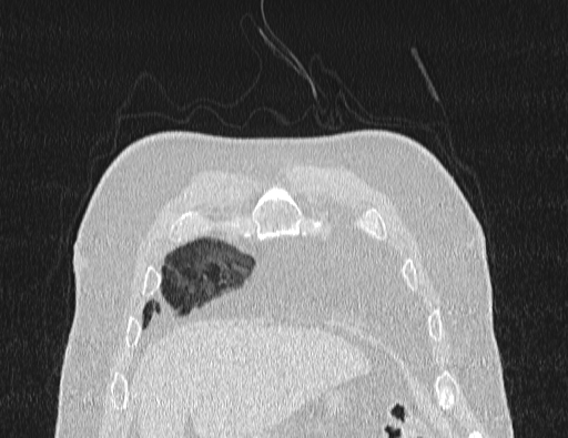 Non specific interstitial pneumonia (NSIP) (Radiopaedia 89725-106798 Coronal lung window 10).jpg