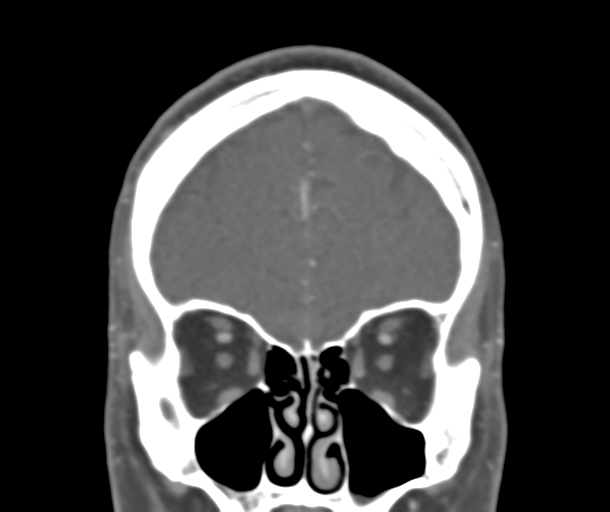 File:Normal CTA head (Radiopaedia 40801-43464 B 24).png