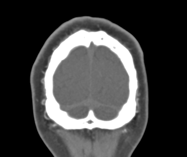 File:Normal CTA head (Radiopaedia 40801-43464 B 89).png