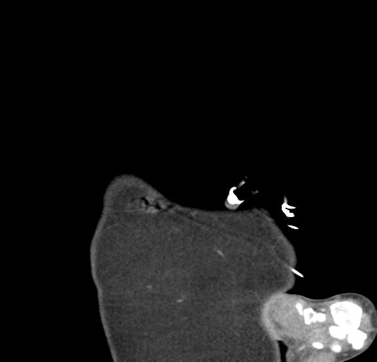 File:Normal CTA thorax (non ECG gated) (Radiopaedia 41750-44704 B 3).png
