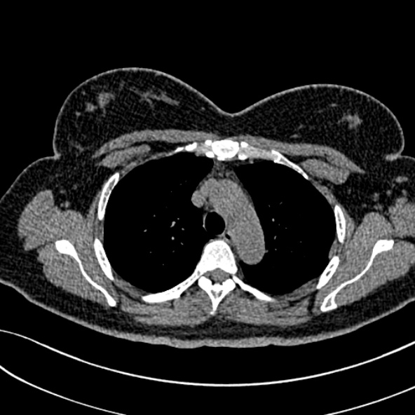 Normal CT chest- adult female (Radiopaedia 52522-58428 Axial non-contrast 40).jpg