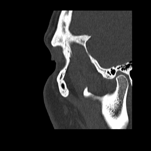 Normal CT paranasal sinuses (Radiopaedia 42286-45390 Sagittal bone window 97).jpg