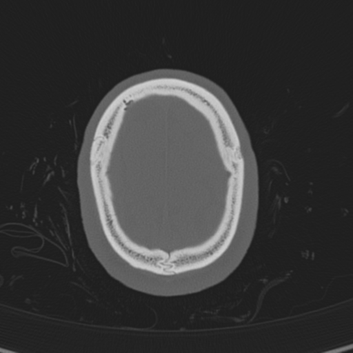 Normal CT skull (Radiopaedia 40798-43459 A 140).png