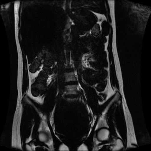 Normal MRI abdomen in pregnancy (Radiopaedia 88001-104541 N 76).jpg