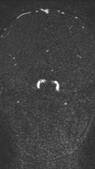 Normal MRI brain with MRV- teenager (Radiopaedia 49425-54553 Coronal MRV 122).jpg