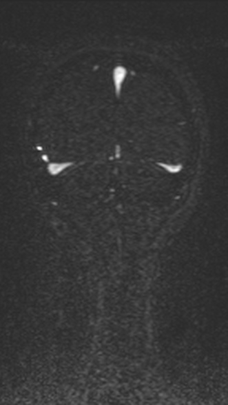 Normal MRI brain with MRV- teenager (Radiopaedia 49425-54553 Coronal MRV 205).jpg