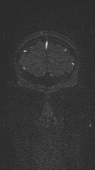 Normal MRI brain with MRV- teenager (Radiopaedia 49425-54553 Coronal MRV 44).jpg
